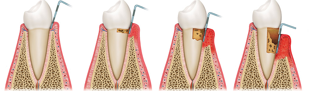 pageheader-periodontaltherapy